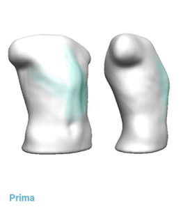 Pectus carinatum trattamenti