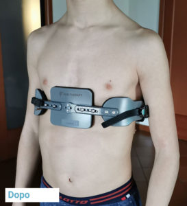 Pectus carinatum tutore